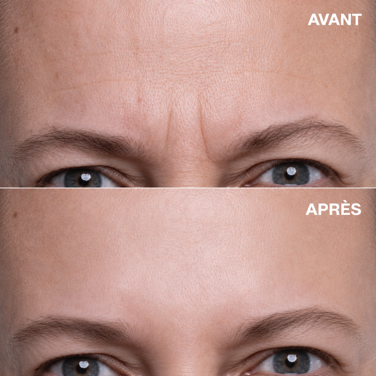 Le patch qui lisse les rides du front ✨ — sans aiguille, sans douleur, dès la première nuit 🌙.